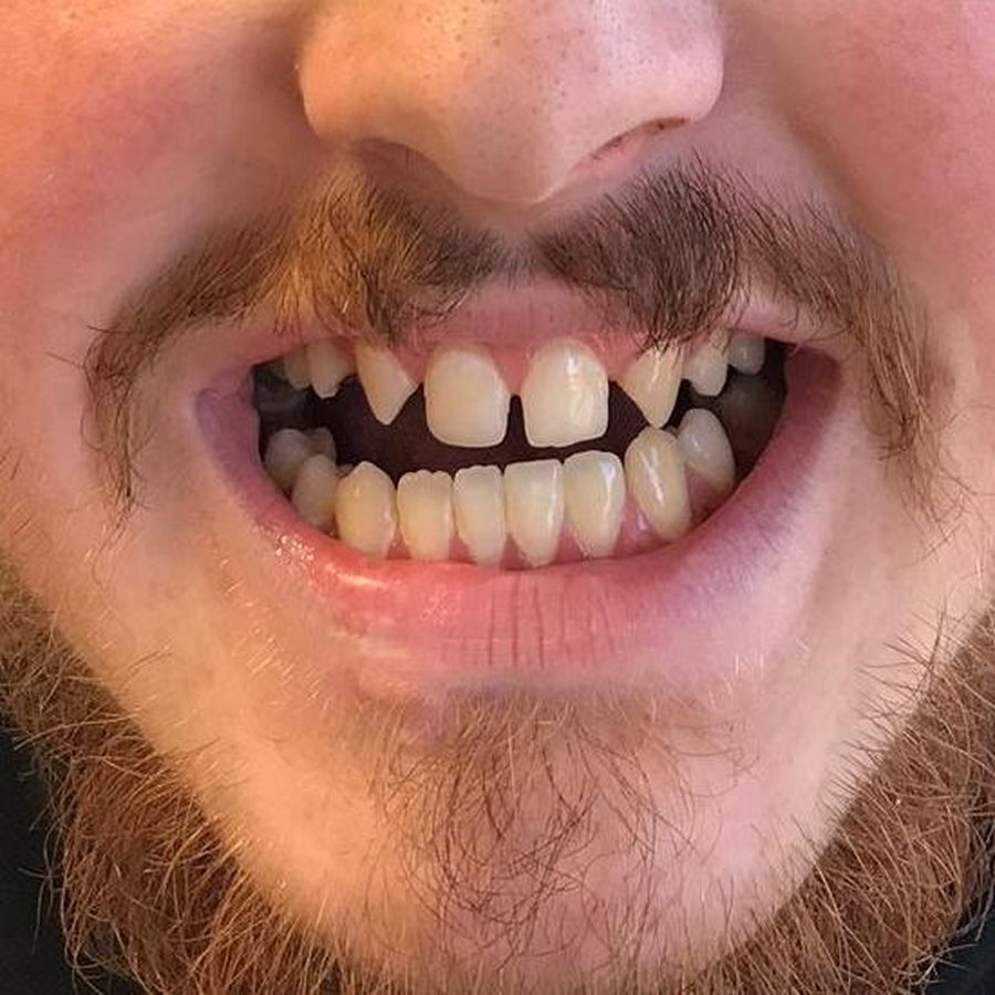 6 month braces & dental bonding - before - 3dental